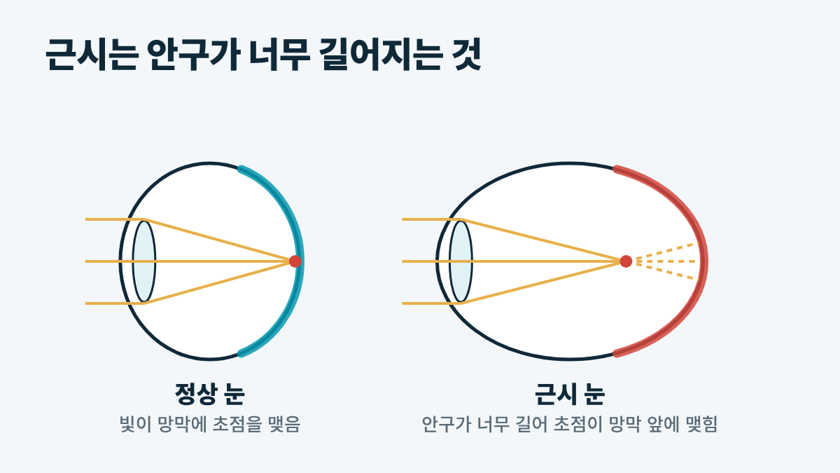 정상 안구와 길어진 근시 안구 비교 그림
